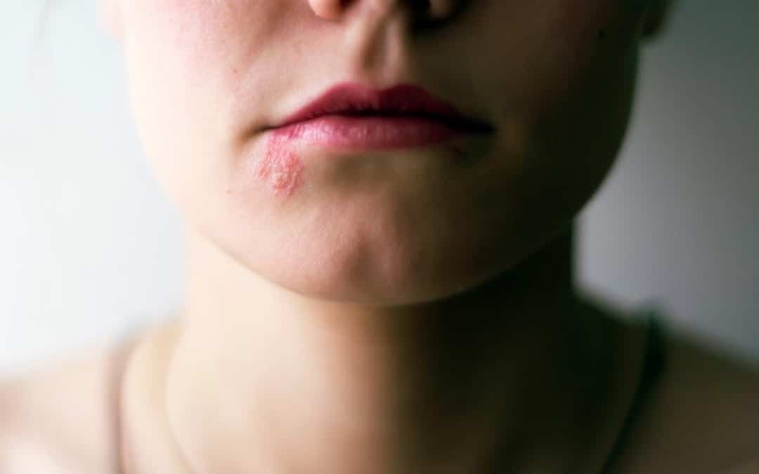 از زونا با عنوان هرپس زوستر نیز یاد می‌شود. این نوع عفونت ویروسی با بثورات قرمز پوستی مشخص می‌شود که می‌تواند باعث درد و سوزش شود. زونا معمولا به صورت رگه‌هایی از تاول در یک طرف بدن، به طور معمول در تنه، گردن یا صورت ظاهر می‌شود. 