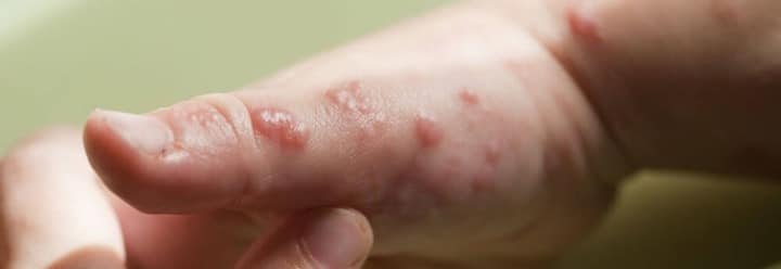 اگر مبتلا به هرپس زوستر هستید، برای جلوگیری از شیوع ویروس وایسلا-زوستر حتما بثورات پوستی و تاول‌های خود را تمیز و پوشیده نگه دارید.