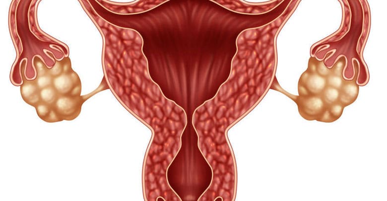 کیست تخمدان؛ علت، علائم و راه‌کارهای درمانی آن