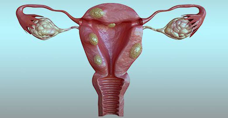 فیبروم رحمی و درمان آن