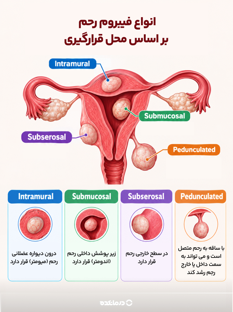 انواع فیبروم رحم بر اساس محل قرارگیری