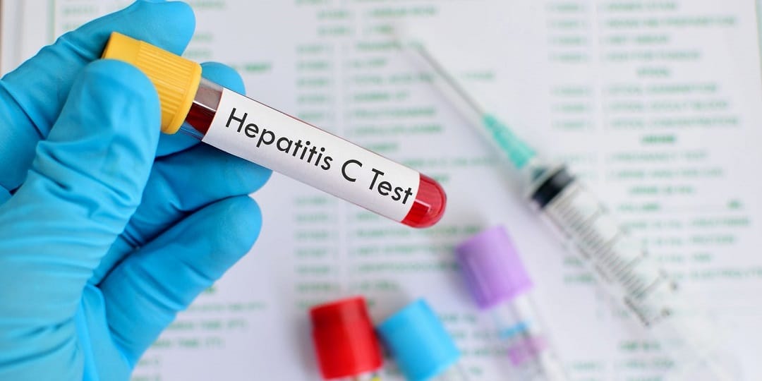 هپاتیت C نوعی از تخریب کبد است که در اثر ویروس HCV (ویروس نوع C) بوجود می‌آید.