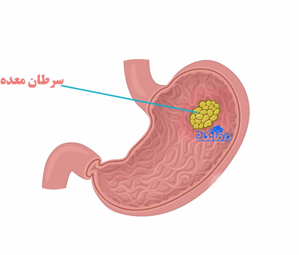 عکس سرطان معده