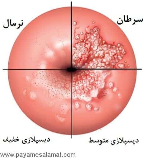 دیسپلازی دهانه رحم