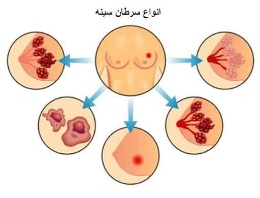 علائم سرطان سینه + روش های تشخیص و درمان سرطان پستان