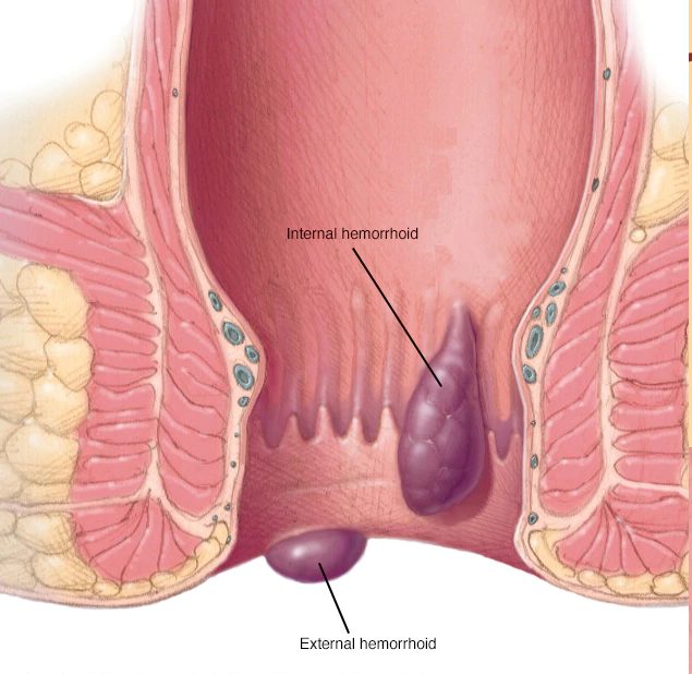 بواسیر، التهاب رگ‌ها در ناحیه مخرج است که گاهی می‌تواند دردناک باشد.