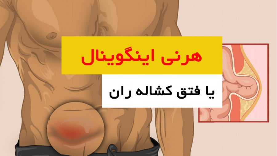 درمان فتق