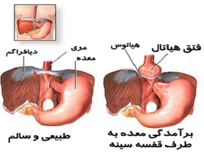 بیماری فتق