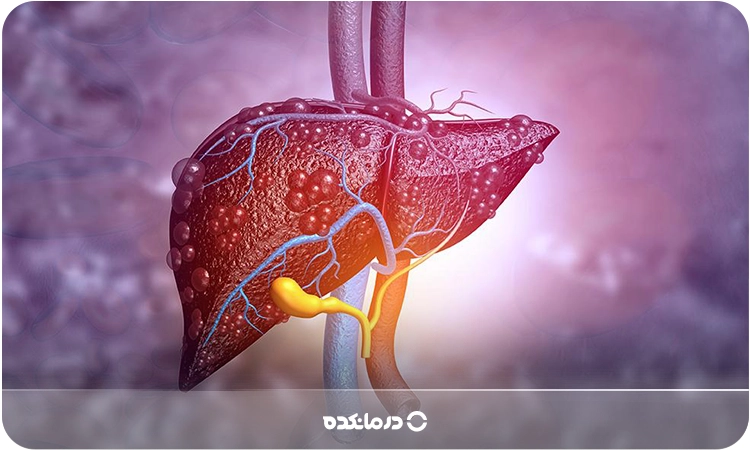 تصویر گرافیکی از کبد مبتلا به التهاب