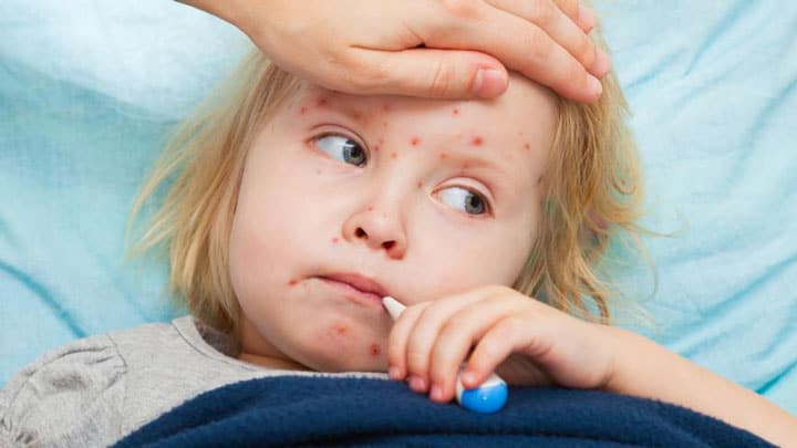 سرخک چیست؟ child with measles - سرخک چیست؟