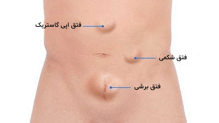 درمان فتق