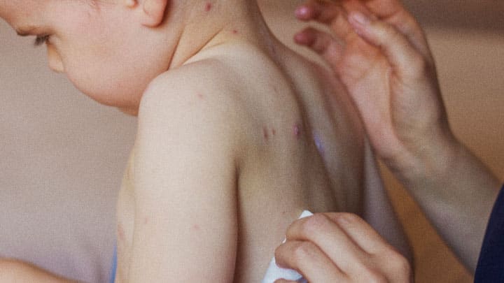 سرخک چیست؟ measles spot remedies - سرخک چیست؟