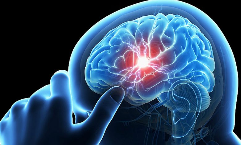آنوریسم مغزی؛ علائم، علت‌ها، تشخیص و راه های درمان