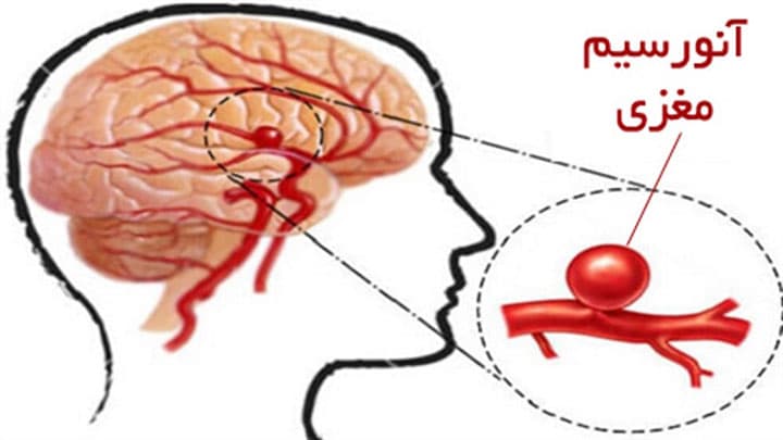 آنوریسم مغزی