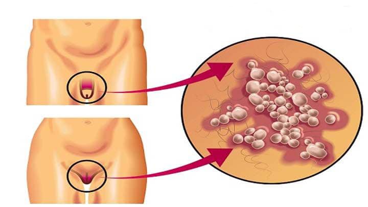 تصویری از تبخال تناسلی در زنان