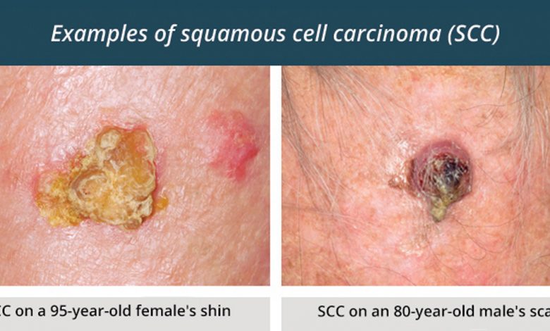 سرطان سلول سنگفرشی (SCC) و هر آنچه که در مورد آن باید بدانید