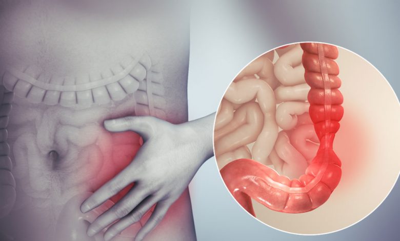 سندروم روده تحریک پذیر؛ تشخیص، علائم و بیماری ها