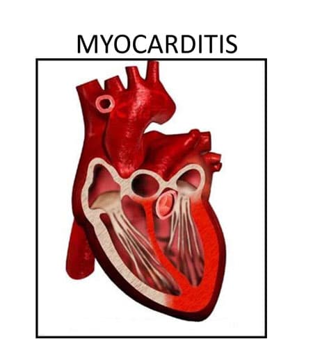 میوکاردیت