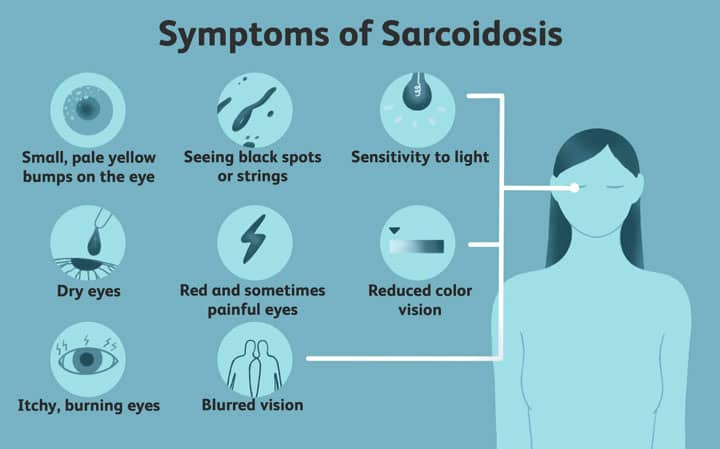 بیماری سارکوئیدوز