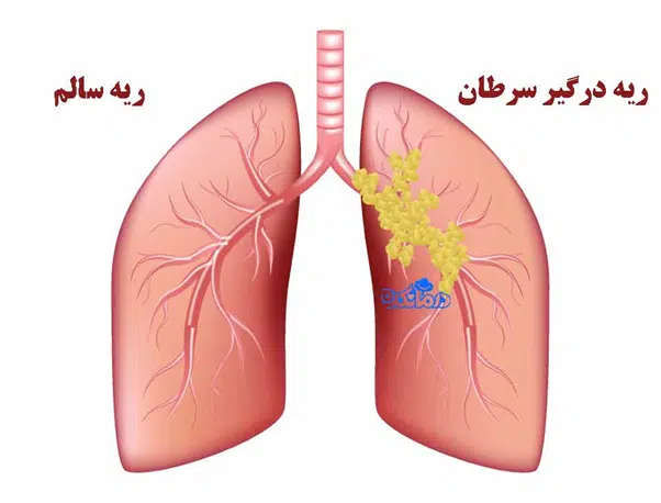 سرطان ریه