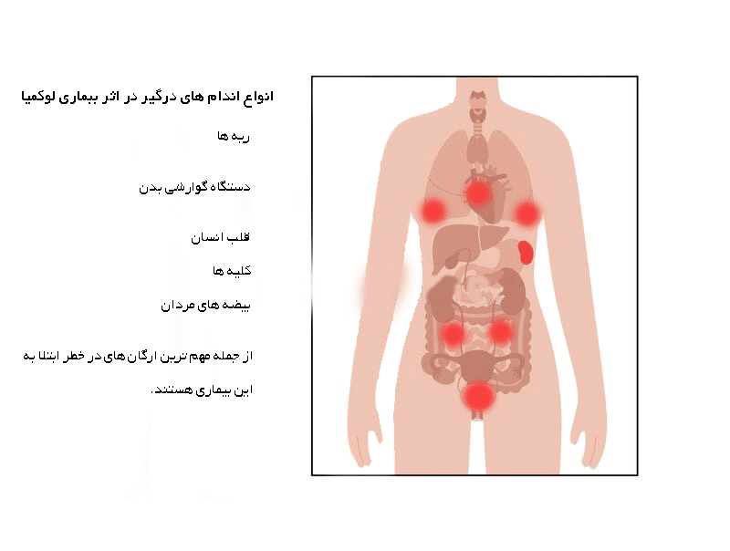 سرطان خون در کجای بدن؟