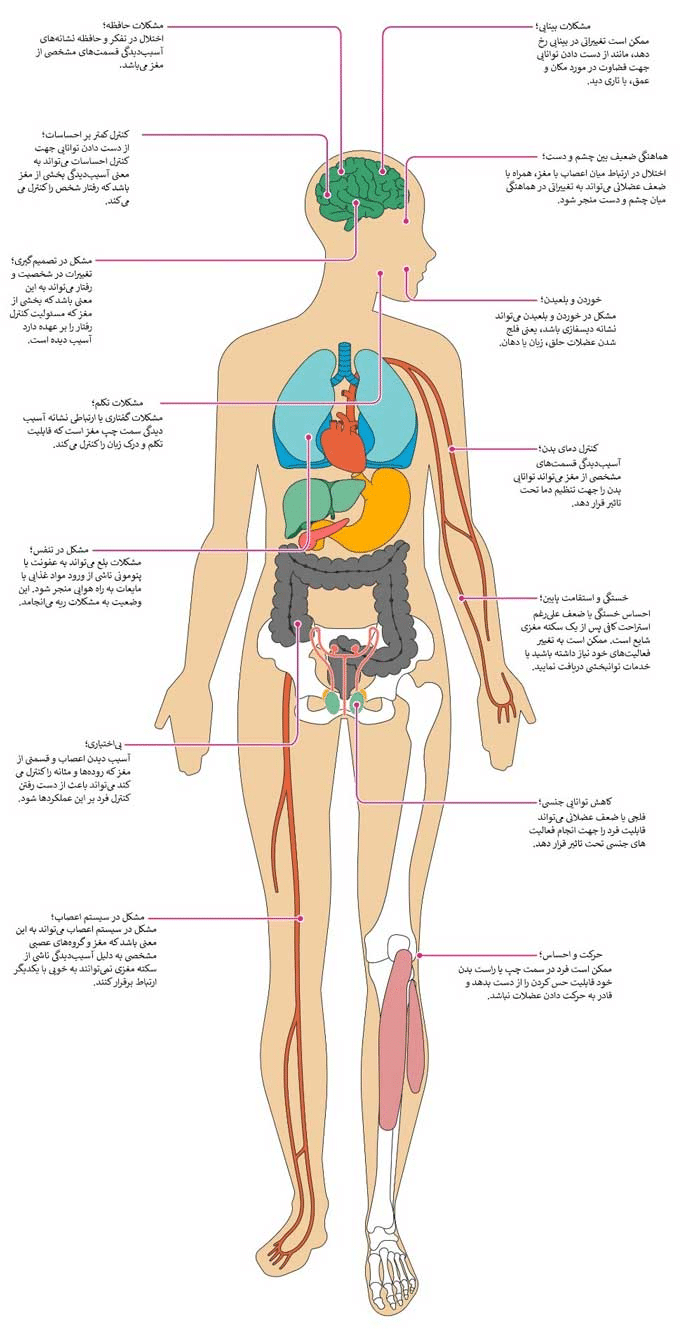 سکته مغزی چه عوارضی دارد؟