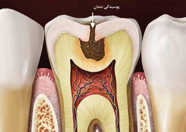 نحوه پوسیده شدن دندان