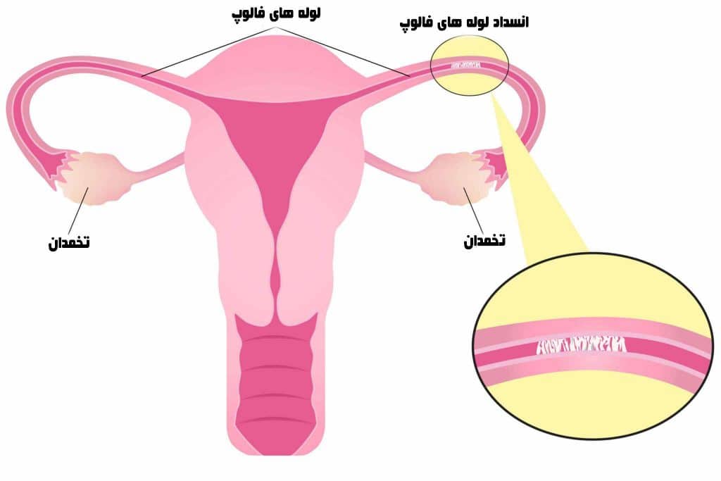 بیماری انسداد-لوله-های-فالوپ