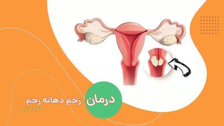 درمان زخم و التهاب دهانه رحم