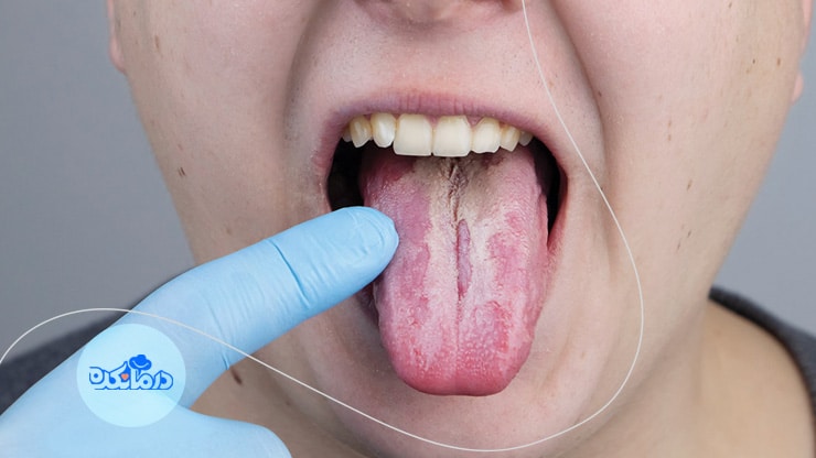 انواع سرطان دهان