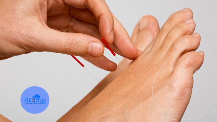 درمان سندروم پای بی‌قرار با طب سوزنی