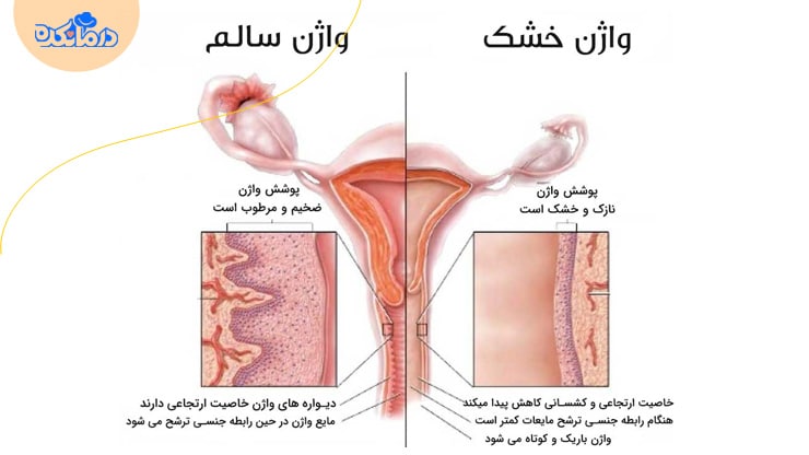 علائم خشکی واژن