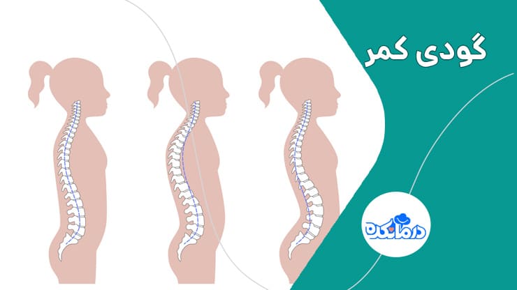 روش های کنترل و درمان گودی کمر