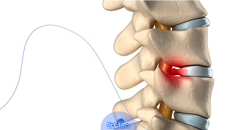 دیسک طبیعی و فتق دیسک