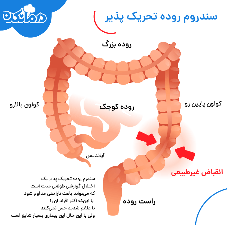 سندروم روده تحریک پذیر