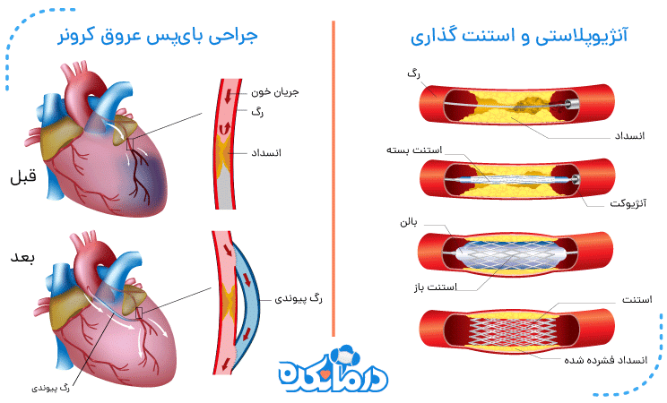 آنژیوپلاستی و جراحی بای پس عروق کرونر