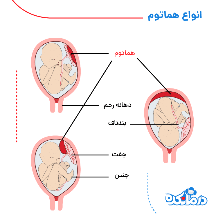 انواع هماتوم بارداری