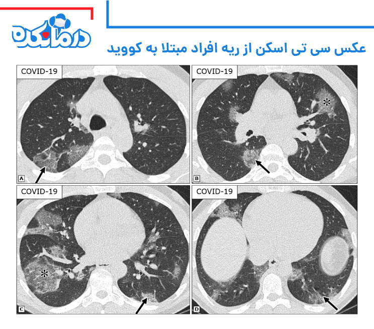 سی تی اسکن ریه افراد مبتلا به کووید 19