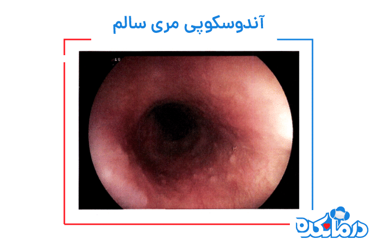 آندوسکوپی مری سالم