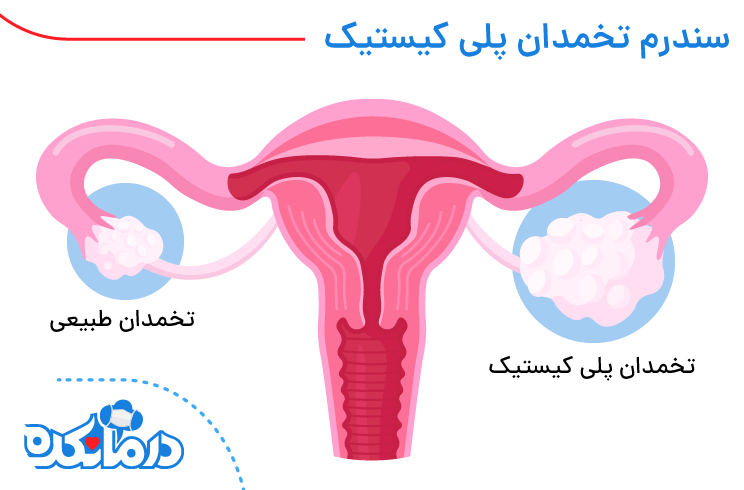 سندروم تخمدان پلی کیستیک