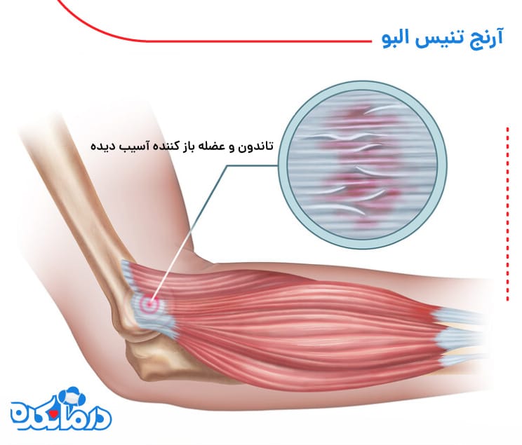 تصویر آرنج تنیس البو