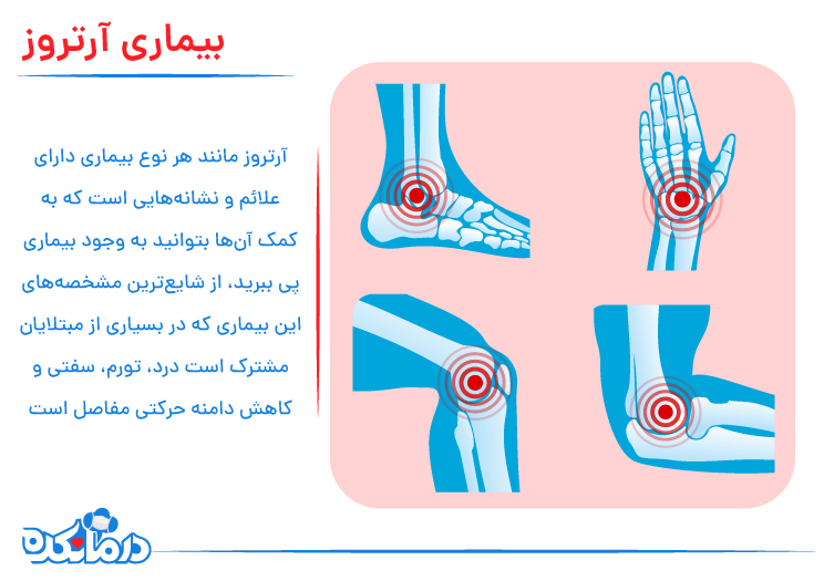 تصویری از بیماری آرتروز