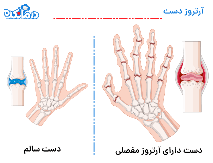 تصویری از آرتروز دست