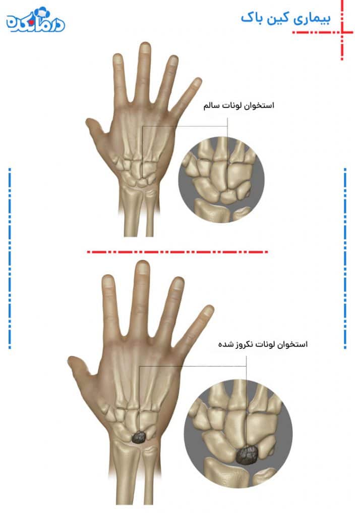 تصویری از یک مچ معمولی و عکس مچ دست مبتلا به بیماری کین باک