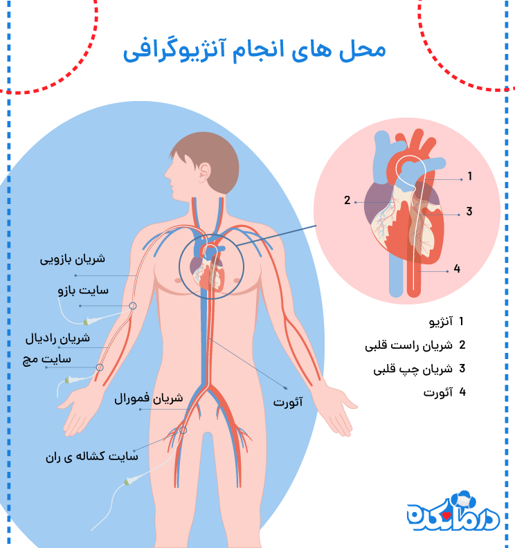 تصویری از محل آنژیوگرافی قلبی