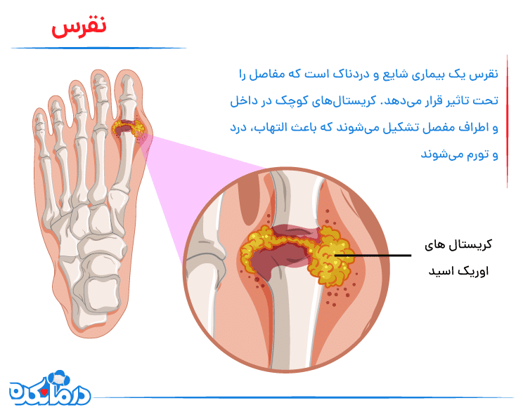 تصویری از بیماری نقرس