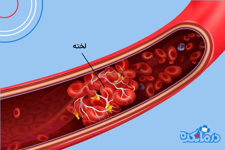 نمایی از لخته شدن خون در رگ ها