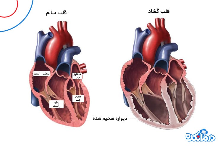 تصویری از گشادی قلب
