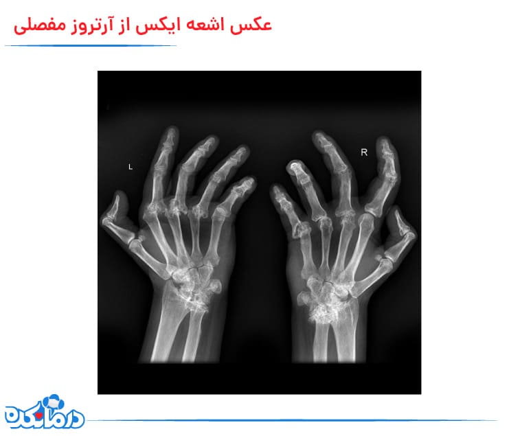 تصویر اشعه ایکس آرتروز مفصلی