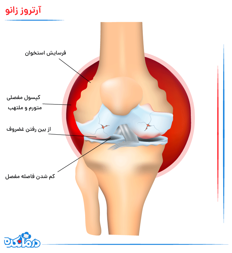 تصویری از درگیری آرتروز در ناحیه قدامی زانو